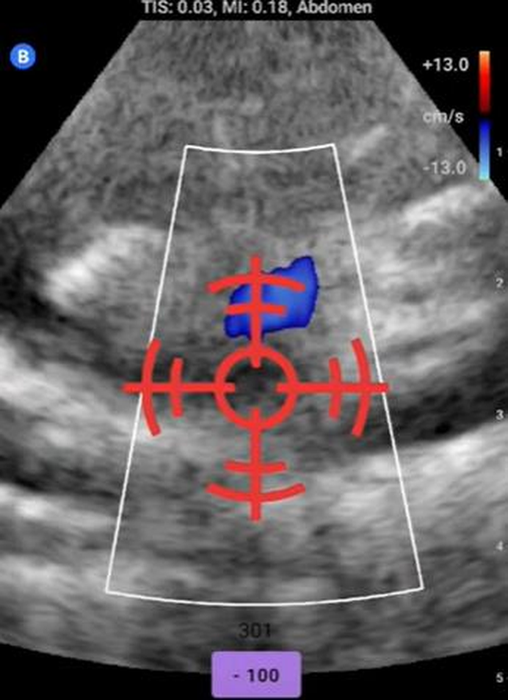 The Butterfly IQ ultrasound view during an AVAD run: a red crosshair marks the needle trajectory, and the target vessel is picked out in blue by Doppler color flow